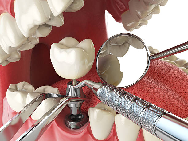 Best Emergency Wisdom Teeth Removal in Konawa, OK
